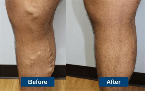 Vein Care .